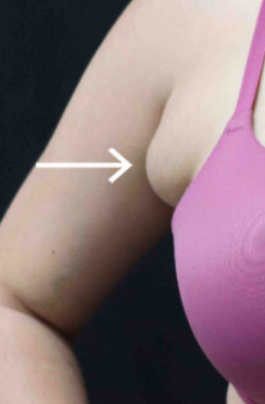 Armpit bulge….. the great dilemma